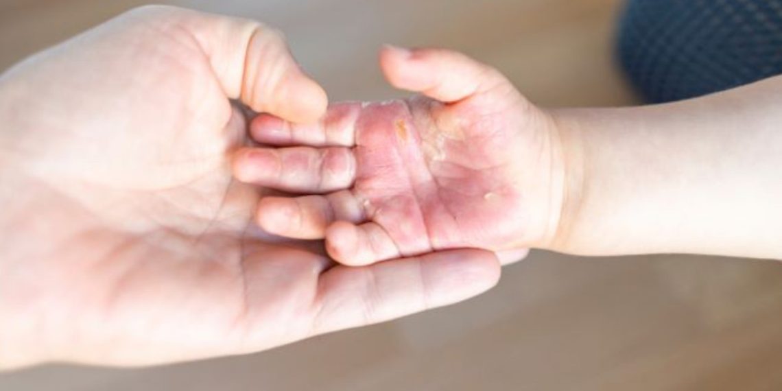 Penanganan tangan balita saat terkena air panas. Foto: LINES