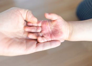 Panduan Pertolongan Pertama Saat Balita Terkena Air Panas