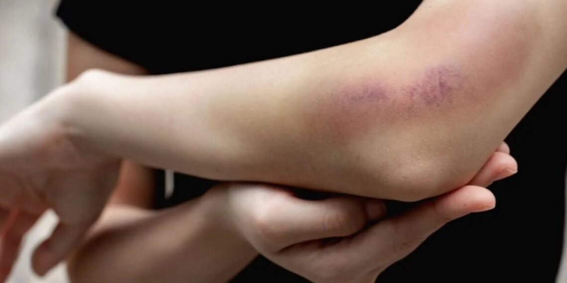 Luka memar sering kali muncul setelah tubuh mengalami benturan dengan benda keras. Foto: LINES